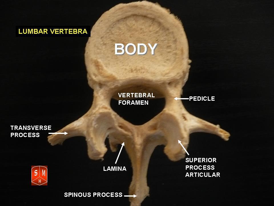 Degenerative spondylolisthesis in the low back