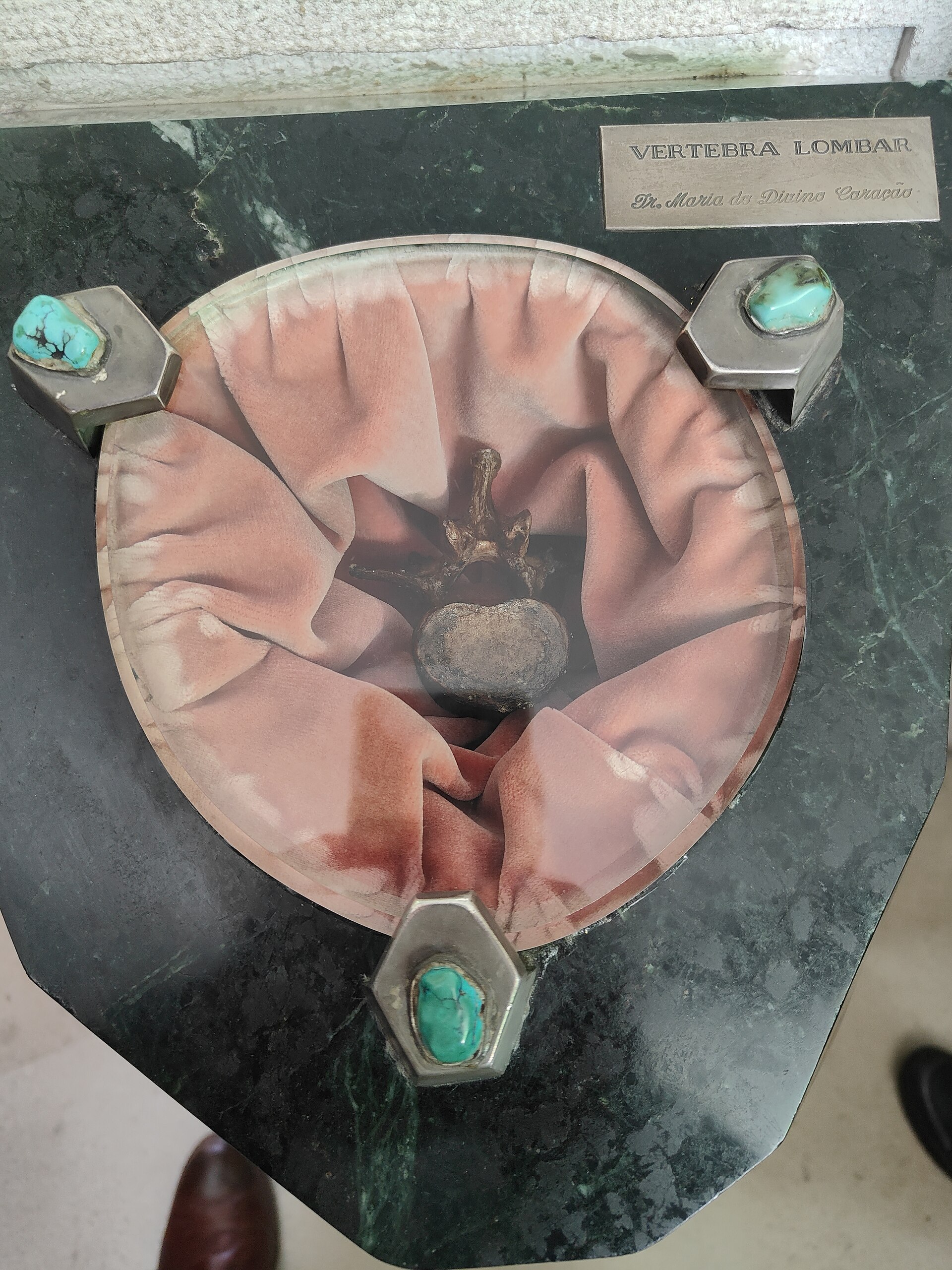 Lumbar disc herniation, in plain language