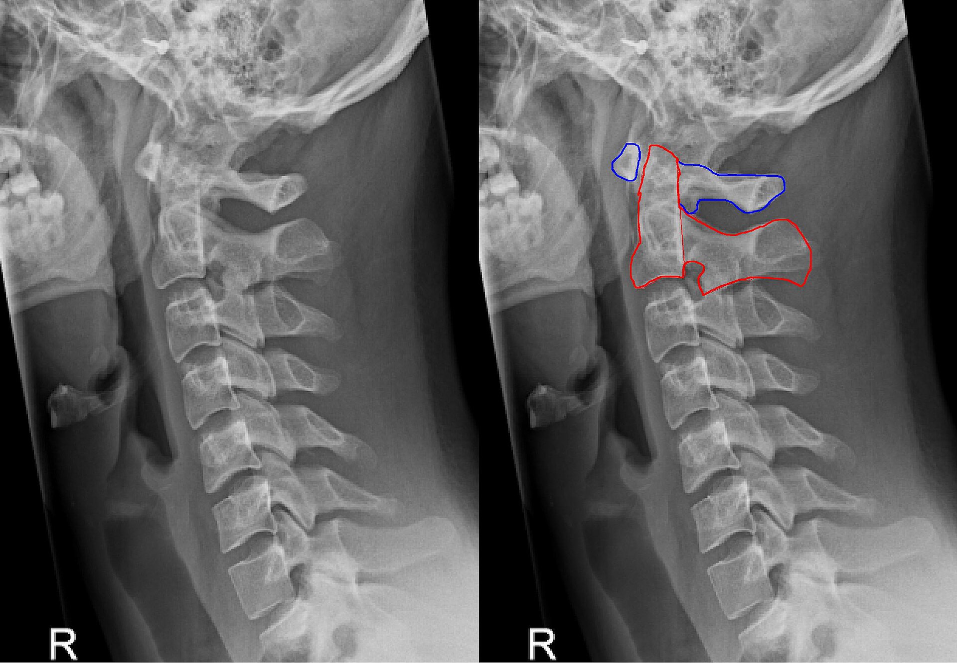 Unilateral Laminotomy for Bilateral Decompression: A Specialized Approach at The Alignment Clinic